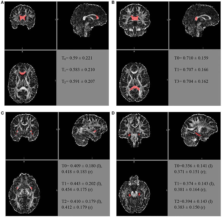 Frontiers Brain Maturation, Cognition and Voice Pattern in a Gender Dysphoria Case under Pubertal Suppression