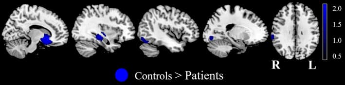 Fig. 3. MID‐evoked activation differences during the reward anticipation phase between AUD patients and HC in the meta‐analysis
