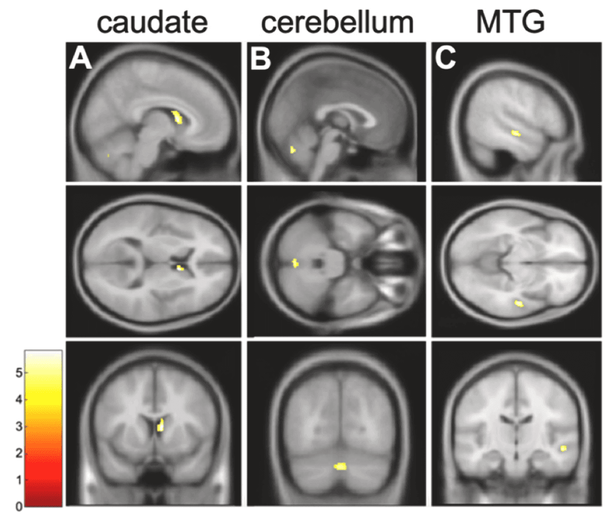 Fig. 1. Decreases in GMV observed at post-treatment relative to start-of-treatment, irrespective of treatment condition.