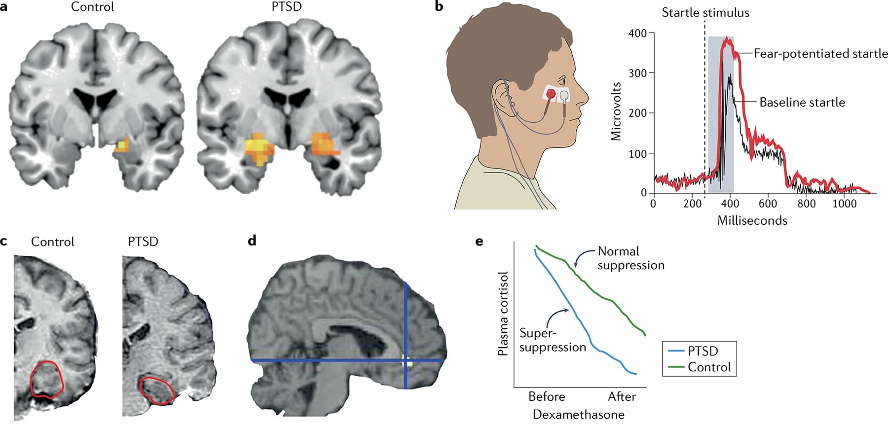 Fig. 2 |. Neurophysiological findings commonly seen in individuals with PTSD.